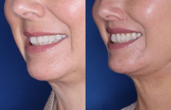 51 year old female 4 months post op from undergoing the Perialar Lip Lift.