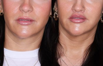 37 year old female 2 months post op from undergoing the perialar lip lift