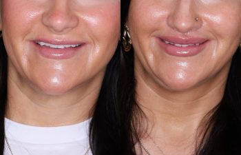 37 year old female 2 months post op from undergoing the perialar lip lift