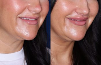 37 year old female 2 months post op from undergoing the perialar lip lift