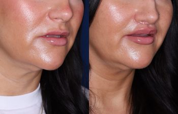 37 year old female 2 months post op from undergoing the perialar lip lift