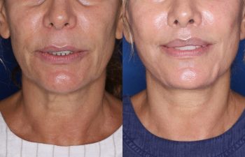 60 year old female 24 months post op from KalosLift (Extended Deep Plane Facelift) with platysmaplasty and perialar lip lift.