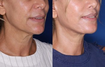 60 year old female 24 months post op from KalosLift (Extended Deep Plane Facelift) with platysmaplasty and perialar lip lift.