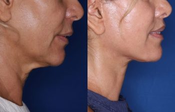 60 year old female 24 months post op from KalosLift (Extended Deep Plane Facelift) with platysmaplasty and perialar lip lift.