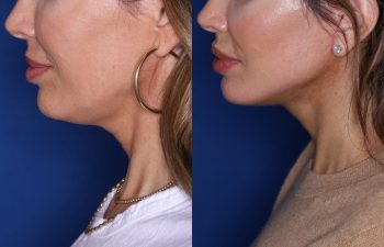 45 year old female 2 months post op from KalosLift (Extended Deep Plane Facelift) with platysmaplasty