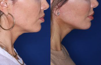 45 year old female 2 months post op from KalosLift (Extended Deep Plane Facelift) with platysmaplasty