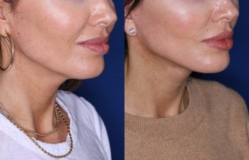 45 year old female 2 months post op from KalosLift (Extended Deep Plane Facelift) with platysmaplasty