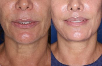 60 year old female 24 months post op from Perialar Lip Lift.