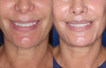 60 year old female 24 months post op from Perialar Lip Lift.