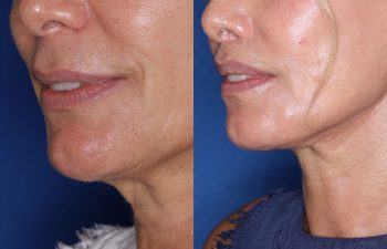 60 year old female 24 months post op from Perialar Lip Lift.