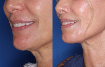 60 year old female 24 months post op from Perialar Lip Lift.