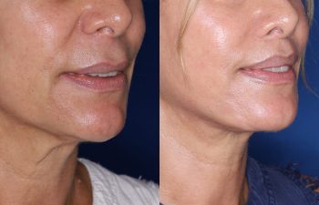 60 year old female 24 months post op from Perialar Lip Lift.