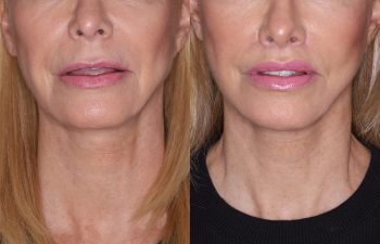 67 year old female 4 months post op from KalosLift (Extended Deep Plane Facelift) with platysmaplasty and perialar lip lift.