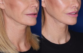 67 year old female 4 months post op from KalosLift (Extended Deep Plane Facelift) with platysmaplasty and perialar lip lift.