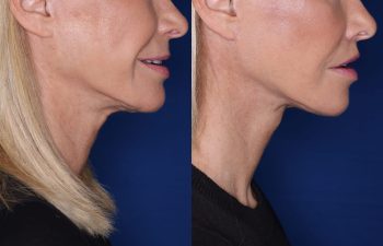 67 year old female 4 months post op from KalosLift (Extended Deep Plane Facelift) with platysmaplasty and perialar lip lift.