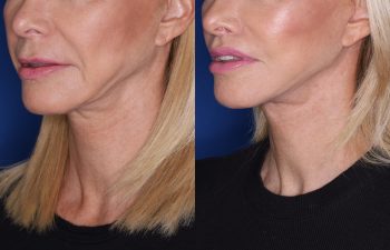 67 year old female 4 months post op from KalosLift (Extended Deep Plane Facelift) with platysmaplasty and perialar lip lift.