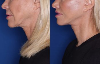 67 year old female 4 months post op from KalosLift (Extended Deep Plane Facelift) with platysmaplasty and perialar lip lift.