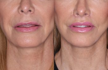 67 year old female 4 months post op from perialar lip lift.