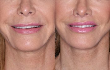 67 year old female 4 months post op from perialar lip lift.