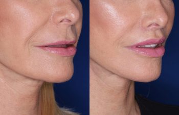 67 year old female 4 months post op from perialar lip lift.