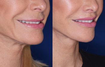 67 year old female 4 months post op from perialar lip lift.