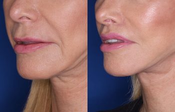 67 year old female 4 months post op from perialar lip lift.