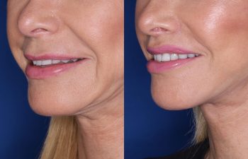 67 year old female 4 months post op from perialar lip lift.