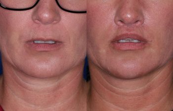 43 year old female 4 months post op from the Perialar Lip Lift.