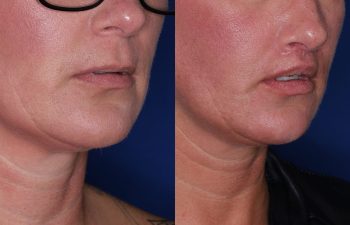 43 year old female 4 months post op from the Perialar Lip Lift.