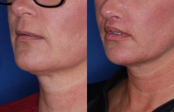 43 year old female 4 months post op from the Perialar Lip Lift.