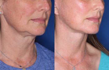 53 year old female 3 months post op from KalosLift (Extended Deep Plane Facelift) with platysmaplasty.