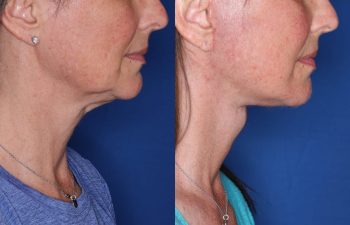 53 year old female 3 months post op from KalosLift (Extended Deep Plane Facelift) with platysmaplasty.