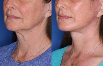 53 year old female 3 months post op from KalosLift (Extended Deep Plane Facelift) with platysmaplasty.