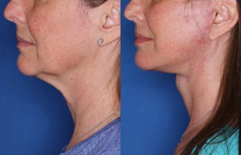 53 year old female 3 months post op from KalosLift (Extended Deep Plane Facelift) with platysmaplasty.