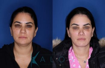 43 year old female patient 1 year post op from KalosLift (Mini Extended Deep Plane Facelift) with Platysmaplasty, Buccal Fat Removal, Perialar Lip Lift, and Rhinoplasty.