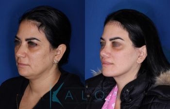 43 year old female patient 1 year post op from KalosLift (Mini Extended Deep Plane Facelift) with Platysmaplasty, Buccal Fat Removal, Perialar Lip Lift, and Rhinoplasty.