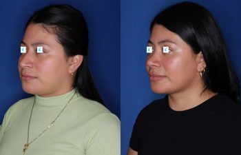 28 year old female about 1 year out from a cosmetic rhinoplasty.