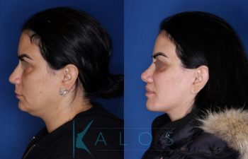 43 year old female patient 1 year post op from KalosLift (Mini Extended Deep Plane Facelift) with Platysmaplasty, Buccal Fat Removal, Perialar Lip Lift, and Rhinoplasty.