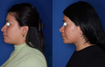 28 year old female about 1 year out from a cosmetic rhinoplasty.