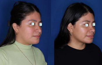 28 year old female about 1 year out from a cosmetic rhinoplasty.