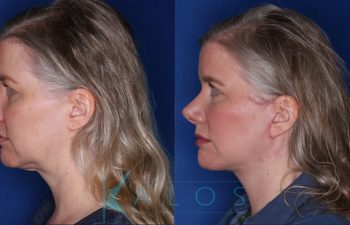 55 year old female patient 2 months post op from KalosLift (Mini Extended Deep Plane Facelift) with Platysmaplasty.