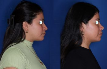 28 year old female about 1 year out from a cosmetic rhinoplasty.