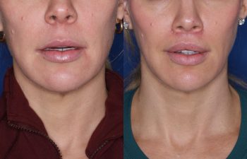 40 year old female patient 4 months out from a perialar lip lift