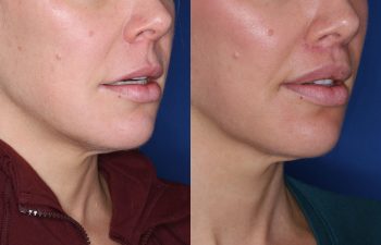 40 year old female patient 4 months out from a perialar lip lift