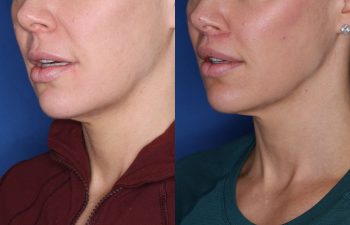 40 year old female patient 4 months out from a perialar lip lift