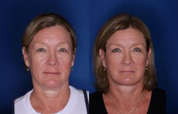 61 year old female 4.5 months following an extended mini deep plane facelift and necklift