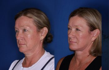 61 year old female 4.5 months following an extended mini deep plane facelift and necklift