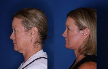 61 year old female 4.5 months following an extended mini deep plane facelift and necklift