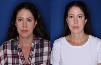 48 year old female 1 year post op from Kaloslift extended deep plane facelift with platysmaplasty neck lift and fat transposition lower eyelid blepharoplasty