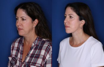 48 year old female 1 year post op from Kaloslift extended deep plane facelift with platysmaplasty neck lift and fat transposition lower eyelid blepharoplasty